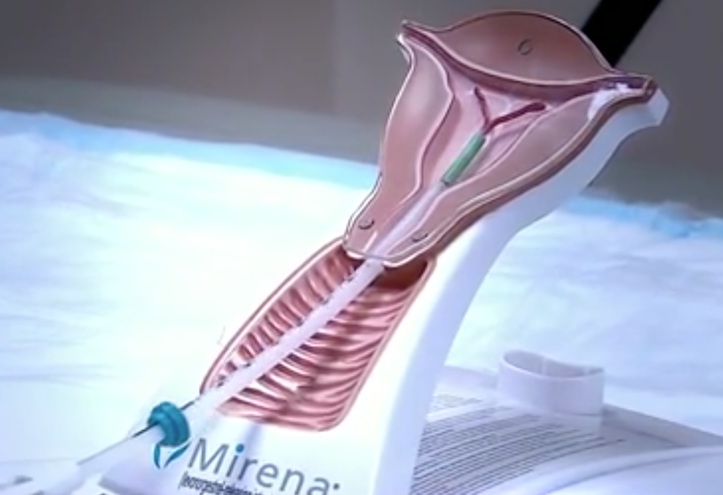 compensation-for-mirena-iud-victims-requiring-removal-surgery-sign-up-now