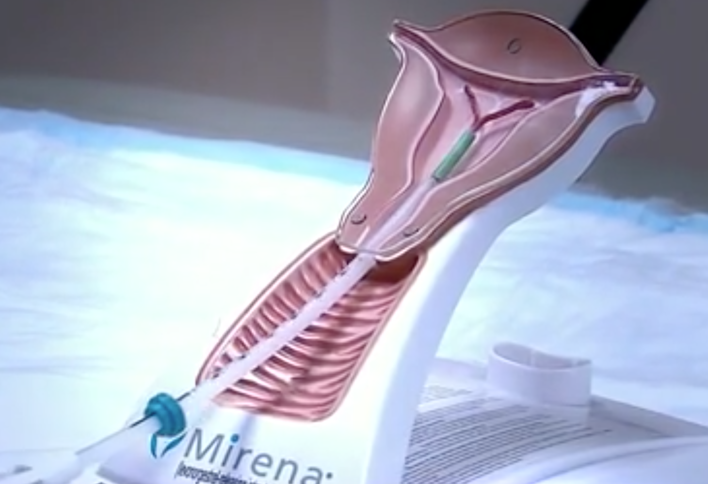 Compensation For Mirena IUD Victims Requiring Removal Surgery Sign Up Now